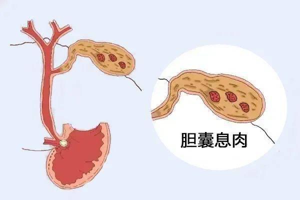 胆囊息肉
