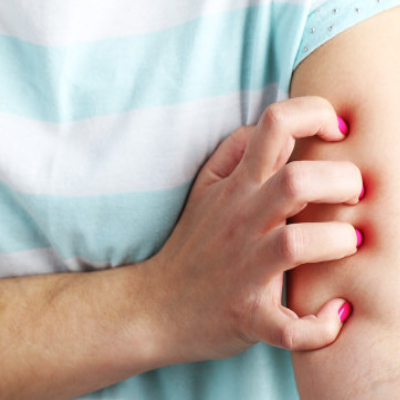 荨麻疹高发的原因找到了，它才是&ldquo;罪魁祸首&rdquo;！现在知道还不晚