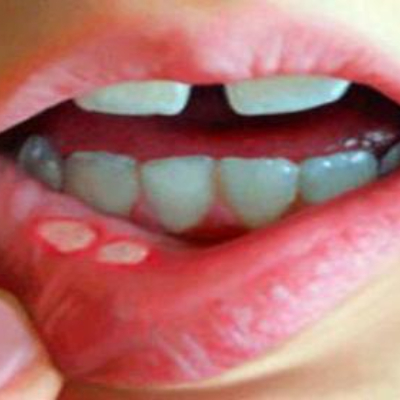 扁平苔藓总是反反复复？老中医：做好这 6 点，或许能让你摆脱困扰！